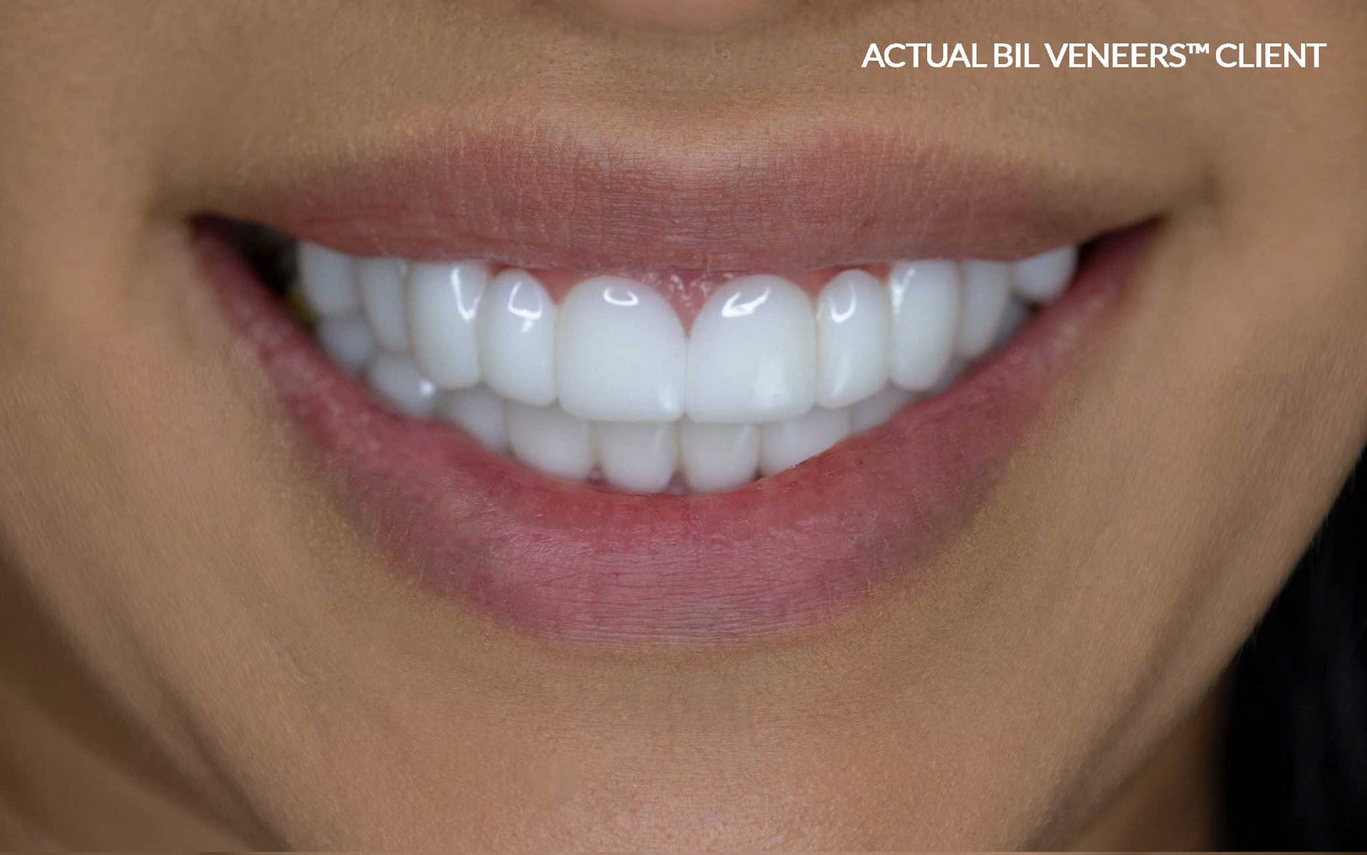 Brighter Image Lab removable veneers Client wearing Brighter Image Lab removable veneers