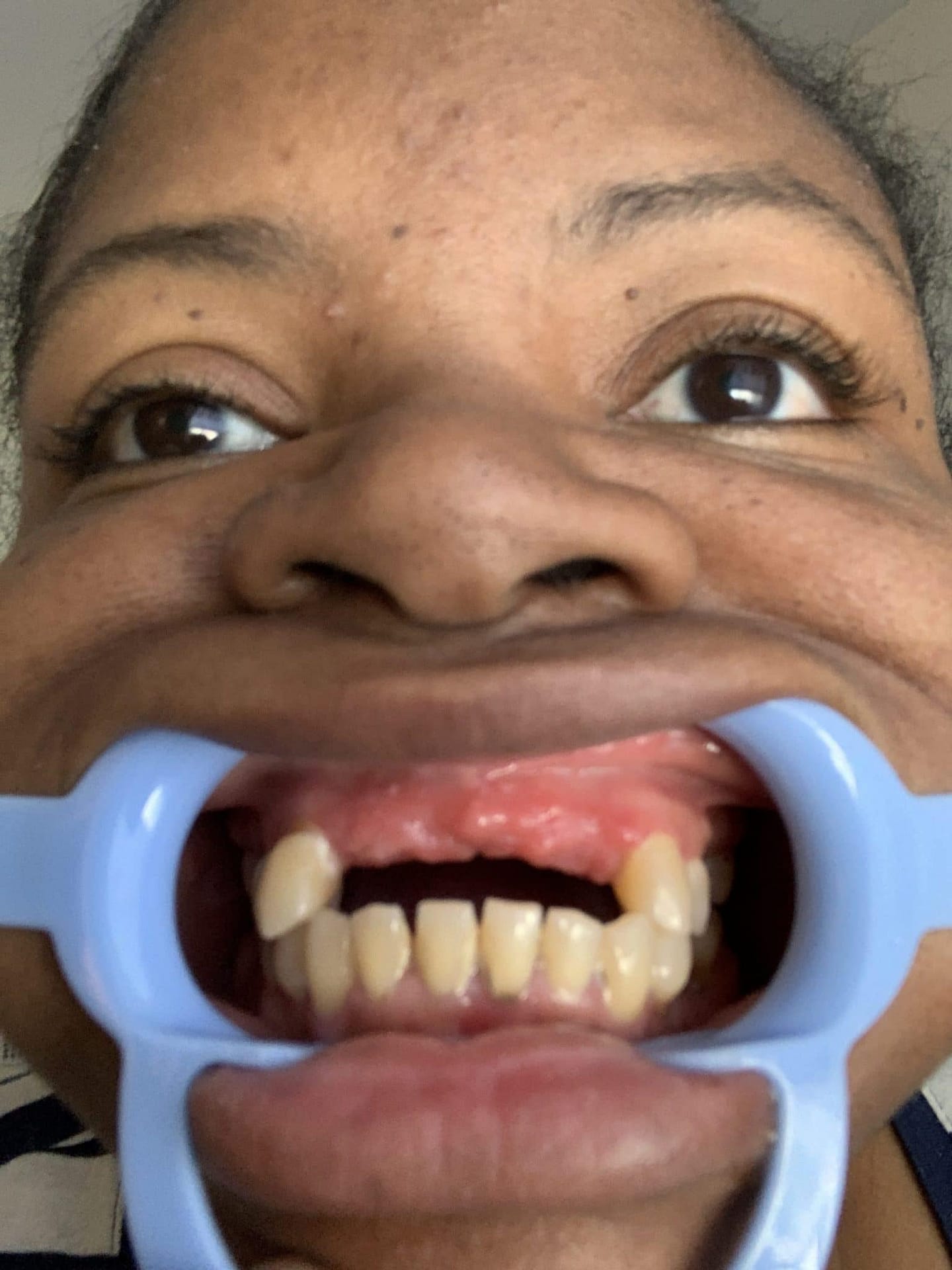 missing teeth missing teeth