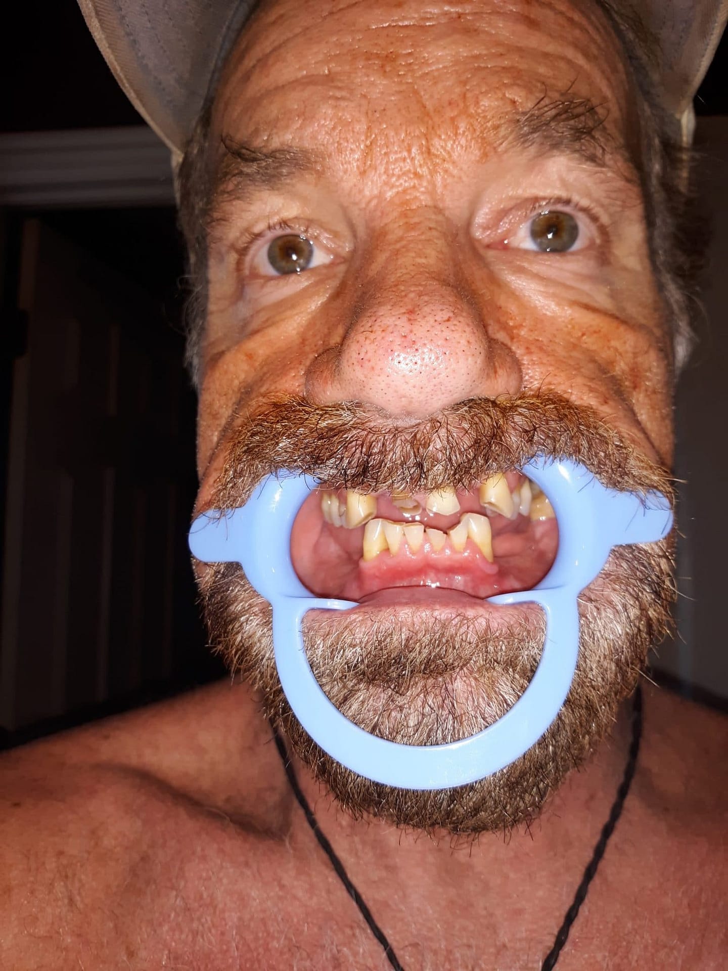 missing teeth missing teeth