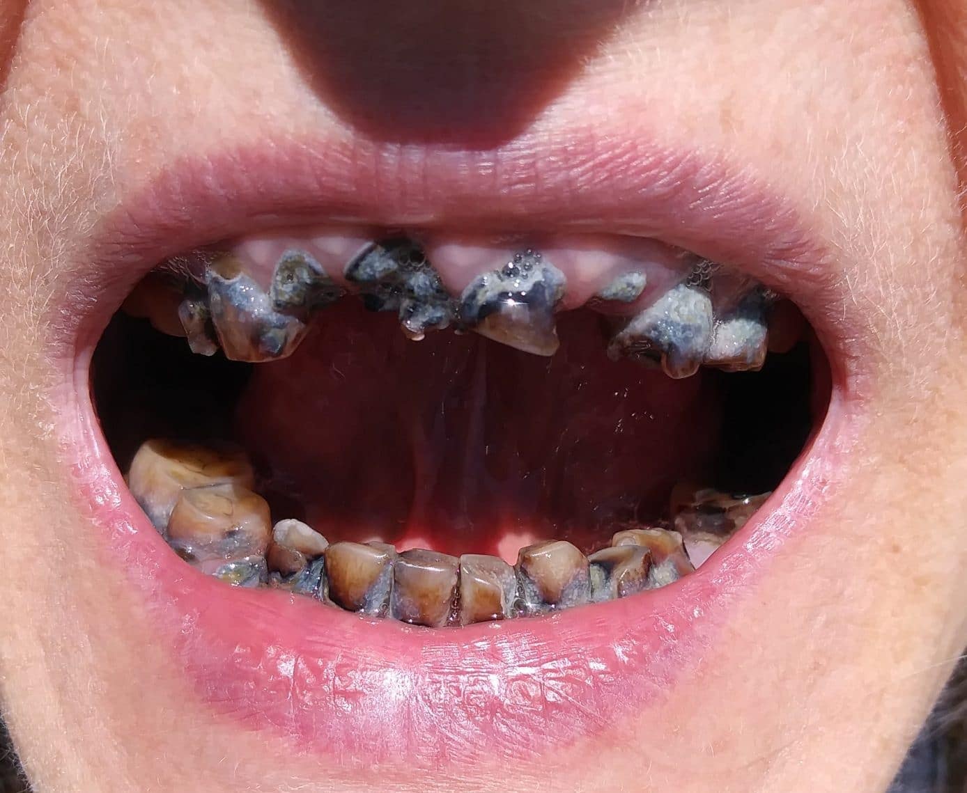 smile makeover smile makeover