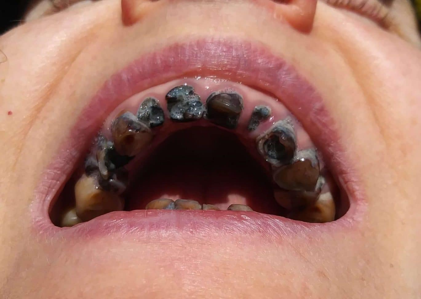 smile makeover smile makeover