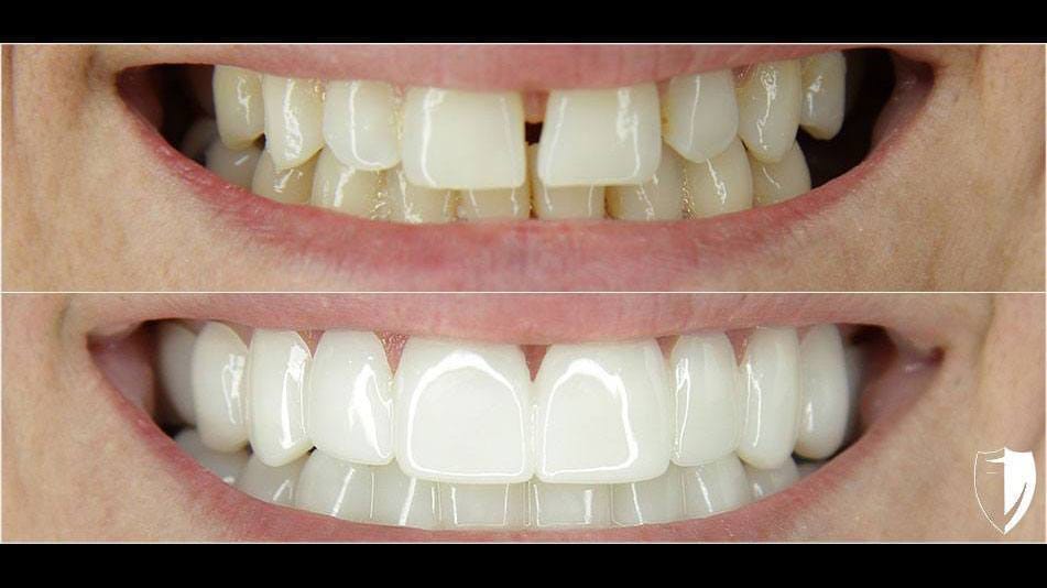 Kareon-H_2020 Heather W. - before and after of actual Brighter Image Lab client