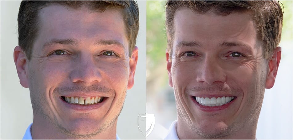 Bil Veneers covers gapped teeth gap teeth fix