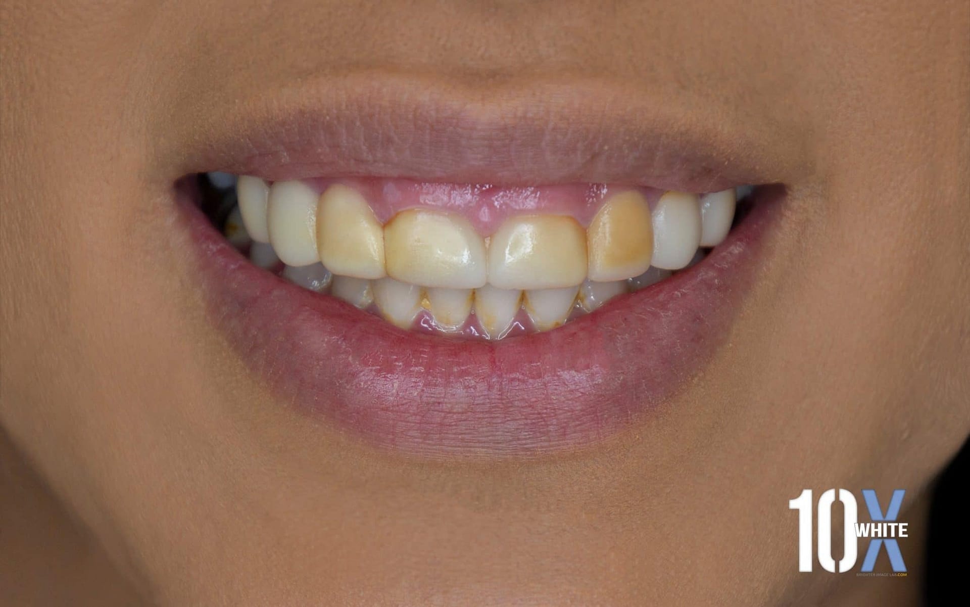 Extrinsic Staining Before Extrinsic Staining Before