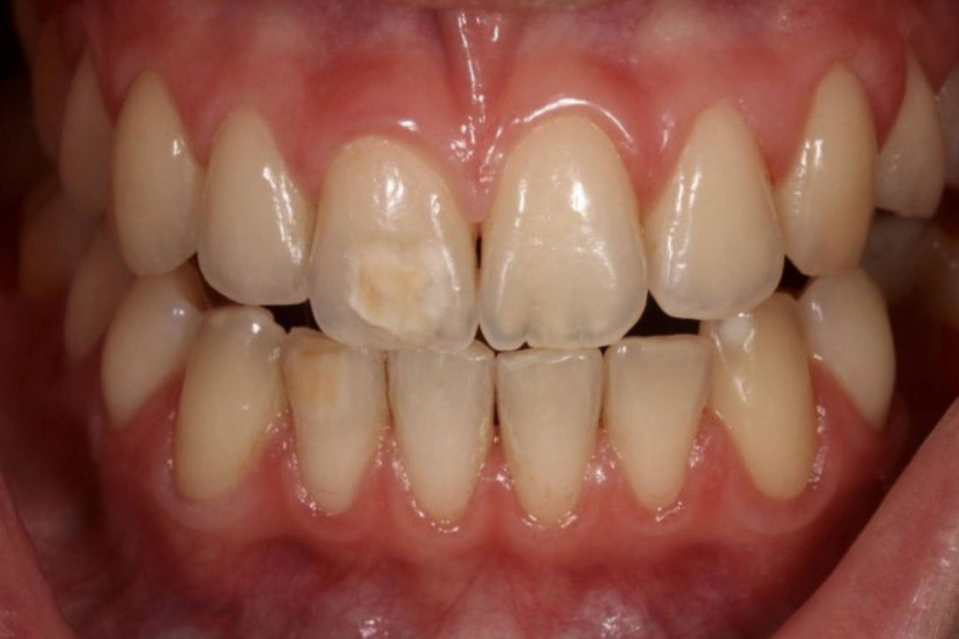 brown spots on teeth brown spots on teeth