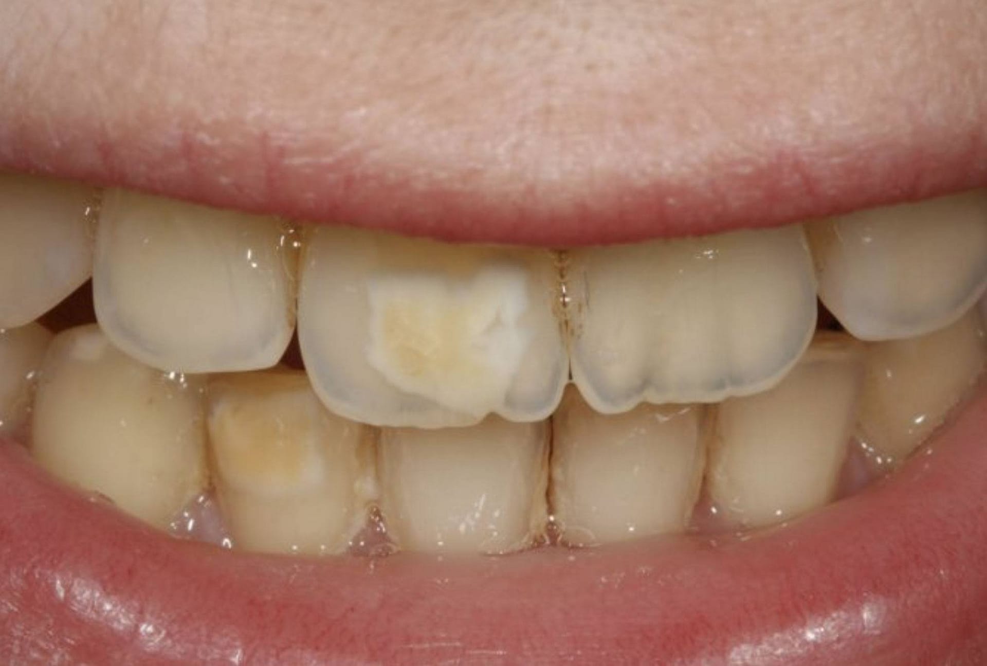 Brown stains on teeth is one of the possible effects of Fluorosis brown stains on teeth