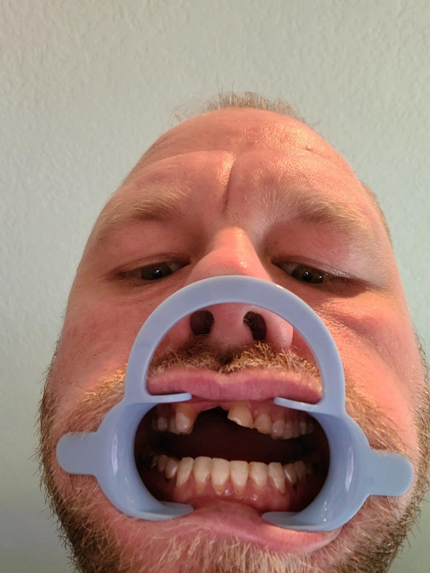 dental partials dental partials