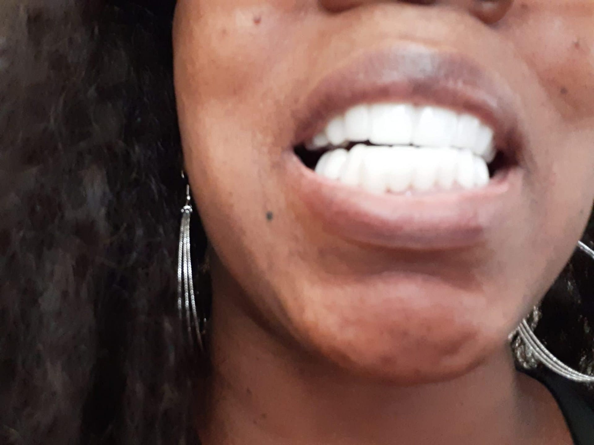 dental partials dental partials