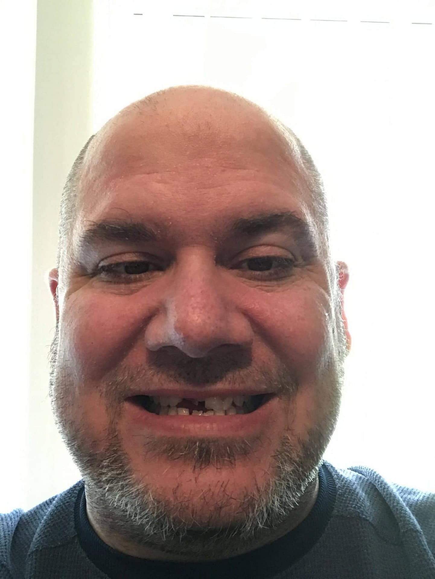 dental partials dental partials