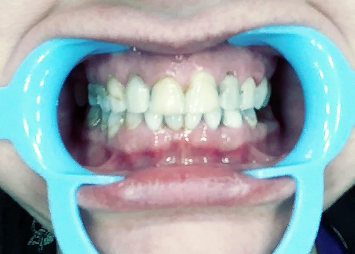 smile makeover smile makeover