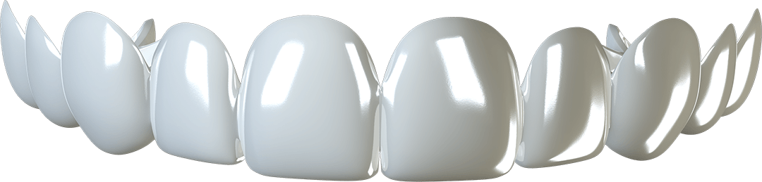 removable-veneers-compressed clip-on-veneers