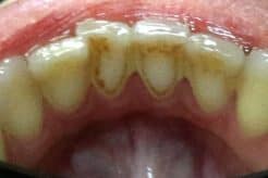 teeth cleaning kit Brighter Image Lab Client Before and After using Bilistic Detox Serum