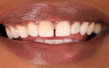 Martina's glimlach daarvoor PressOn Veneers