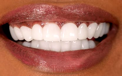 Martina's glimlach na PressOn Veneers