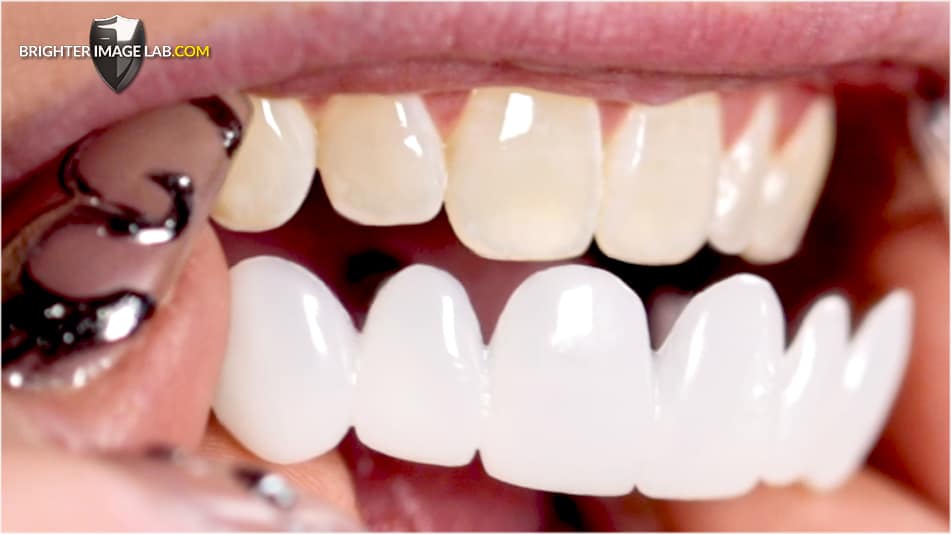 PuttingInVeneers_CloseUp-WEB