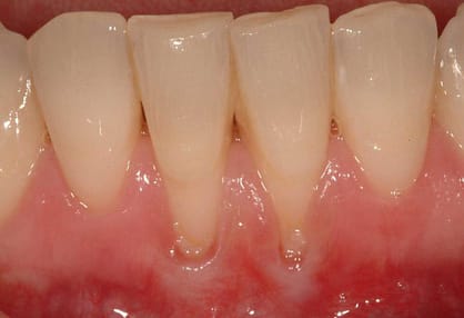 Das Zurückziehen von Zahnfleischlinien kann eine Warnung vor anderen mündlichen Problemen sein
