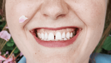 Les facettes sont la solution parfaite pour les dents écartées