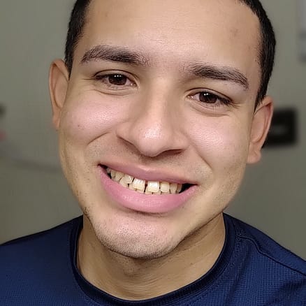 transformación de la sonrisa