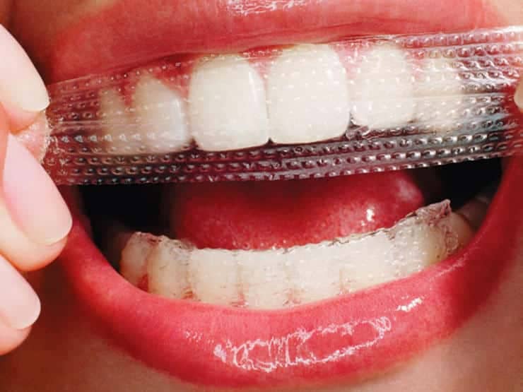 Teeth whitening strips, do they work?