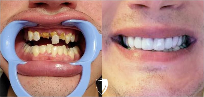 Gebrochene Zähne reparieren