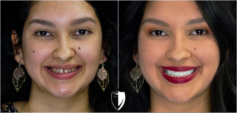 Perfect Smile Makeover ohne Invisalign oder Cosmetic Dentist!