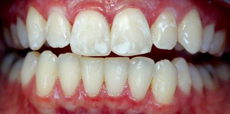 Manchas blancas en los dientes y lo que puedes hacer al respecto.