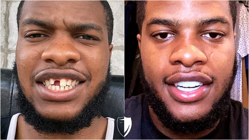 missing-teeth-before-and-after