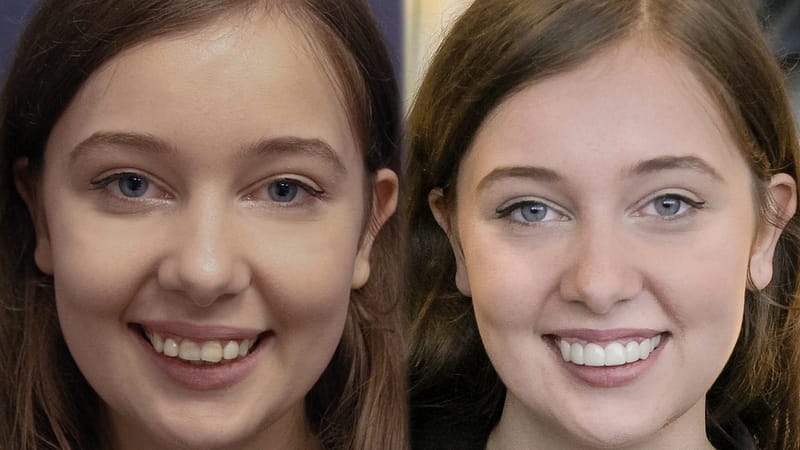 LA Smile Makeover for California Girl by Brighter Image Lab