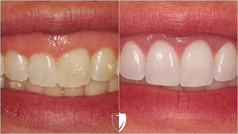 Gum Contouring Before and After