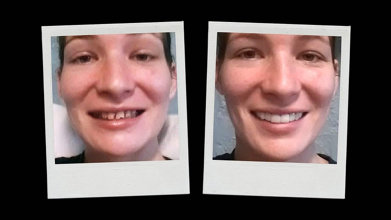 New Smile Makeover per Wendy in Florida