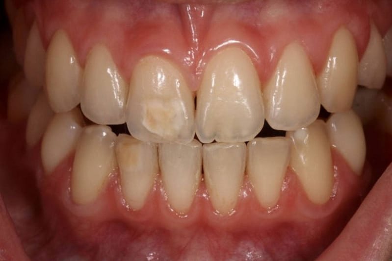 6 Причины появления коричневых пятен на зубах