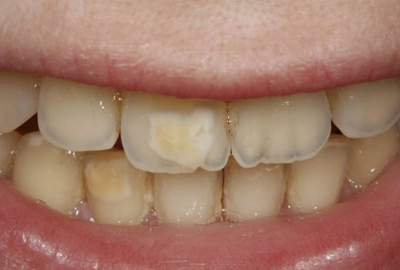 Las manchas marrones en los dientes es uno de los posibles efectos de la fluorosis.