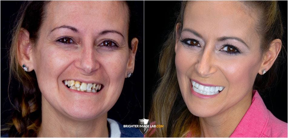 BILVeneers 替代化妆品牙科 Brighter Image Lab