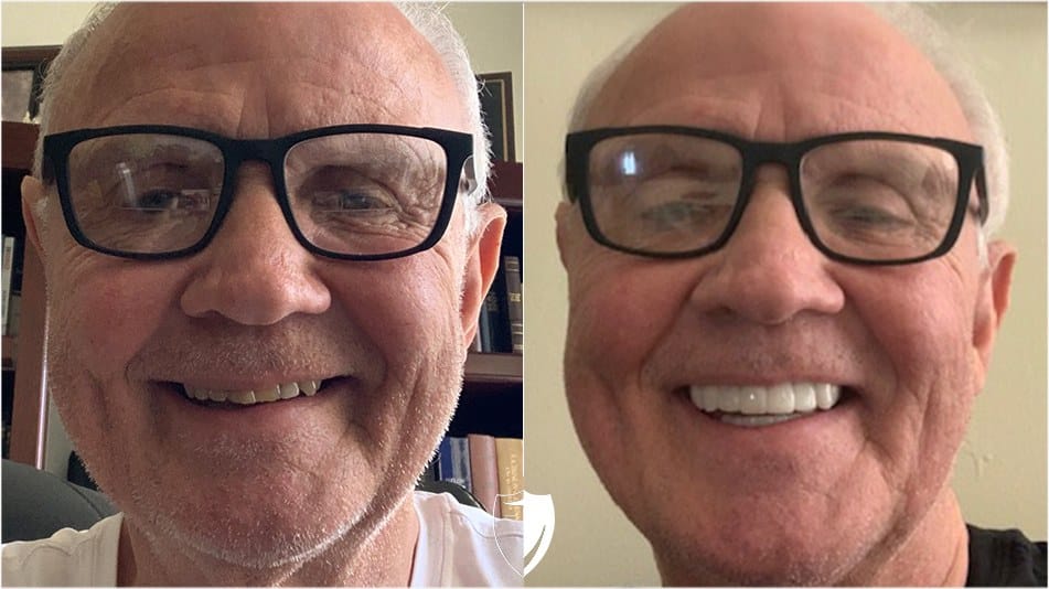 bilveneers-client-kenneth-a