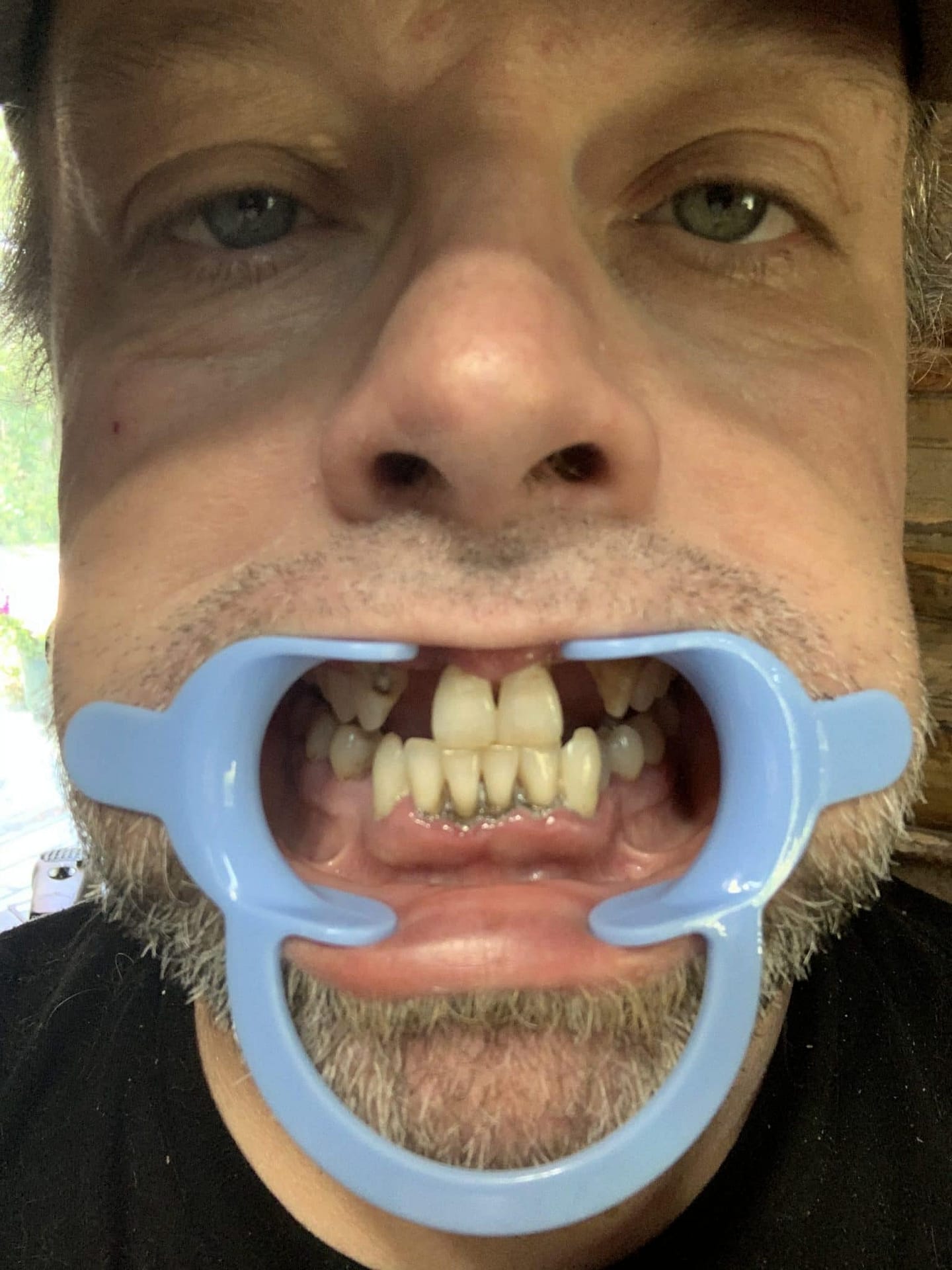 牙齿局部