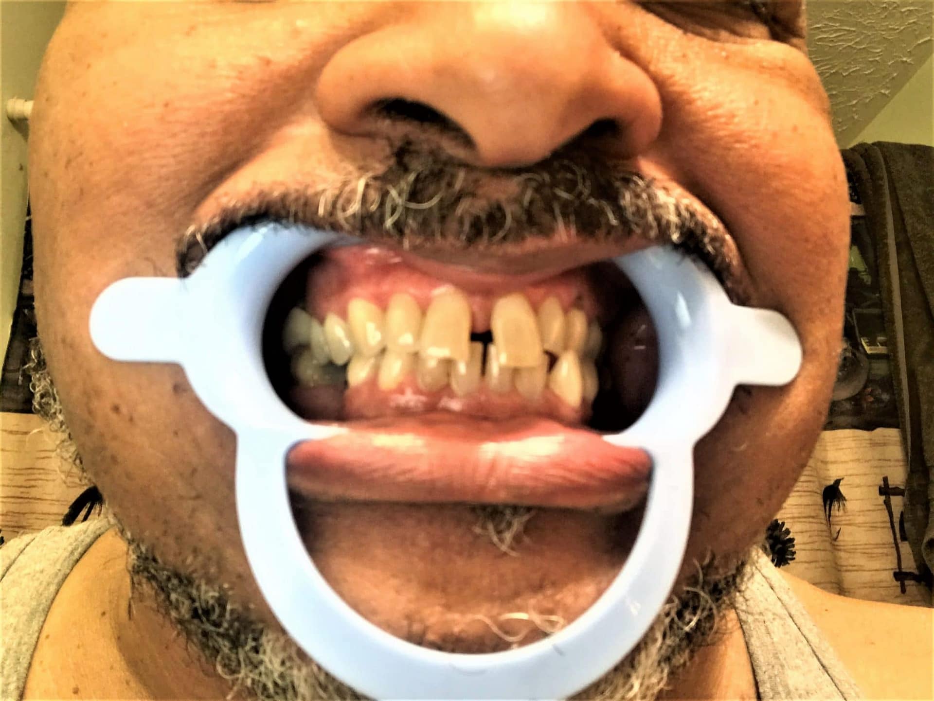 разрыв зубов