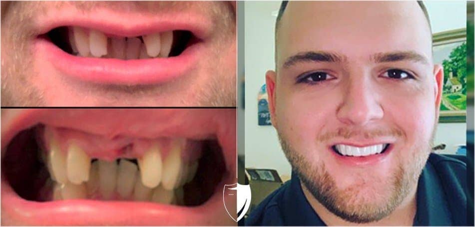 Wir decken Ihre fehlenden Zähne ab - Bil Veneers by Brighter Image Lab
