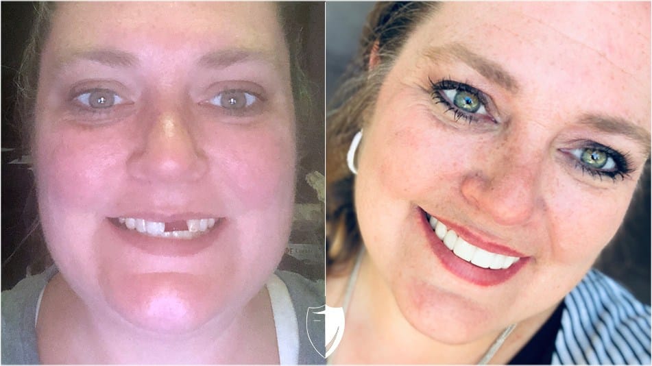 trasformazione del dente mancante