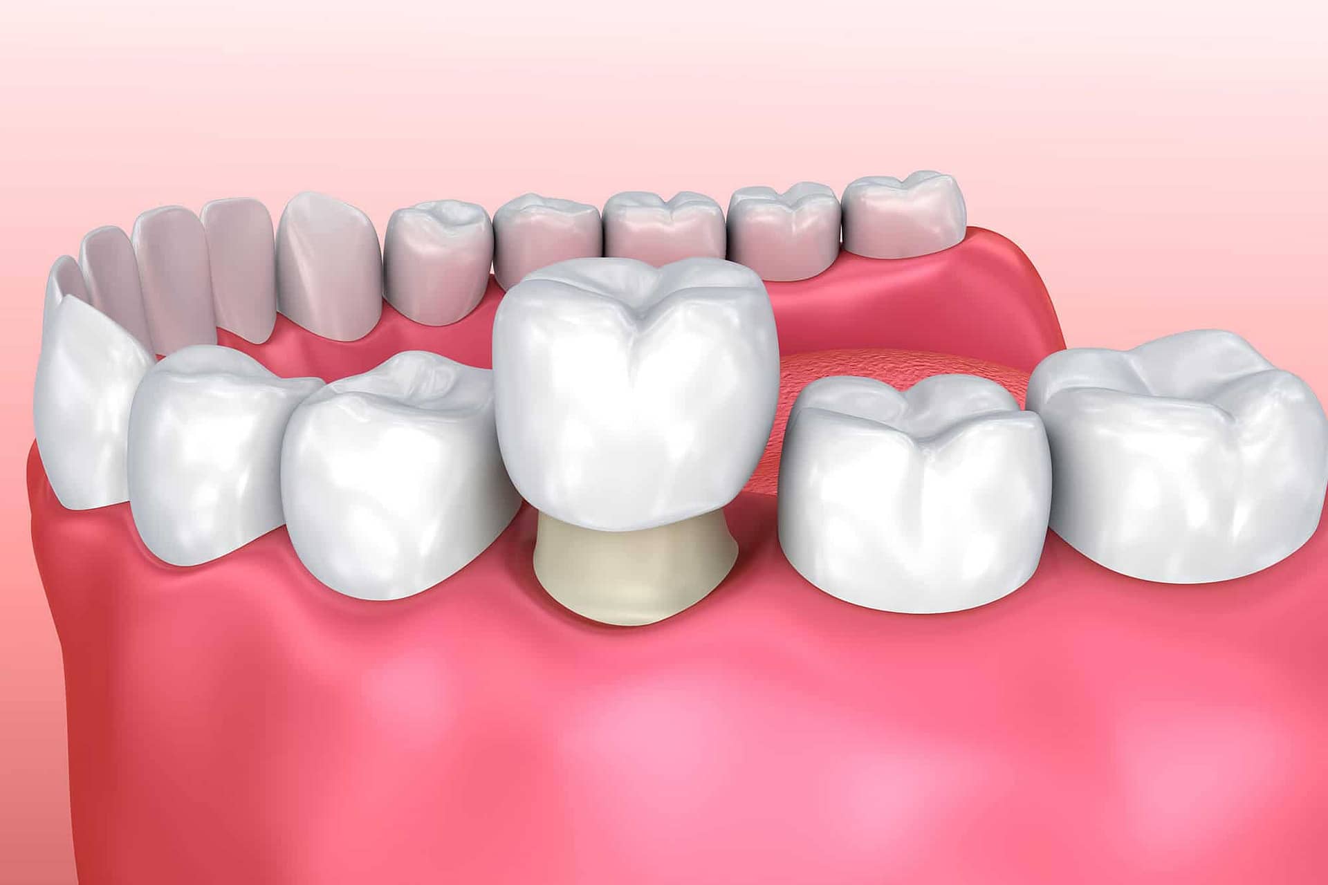 teeth shaving