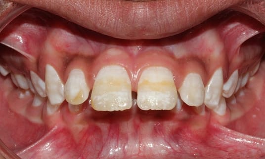 white spots on teeth