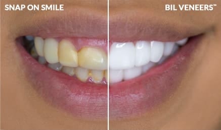 Snap-On Smile против BilVeneer