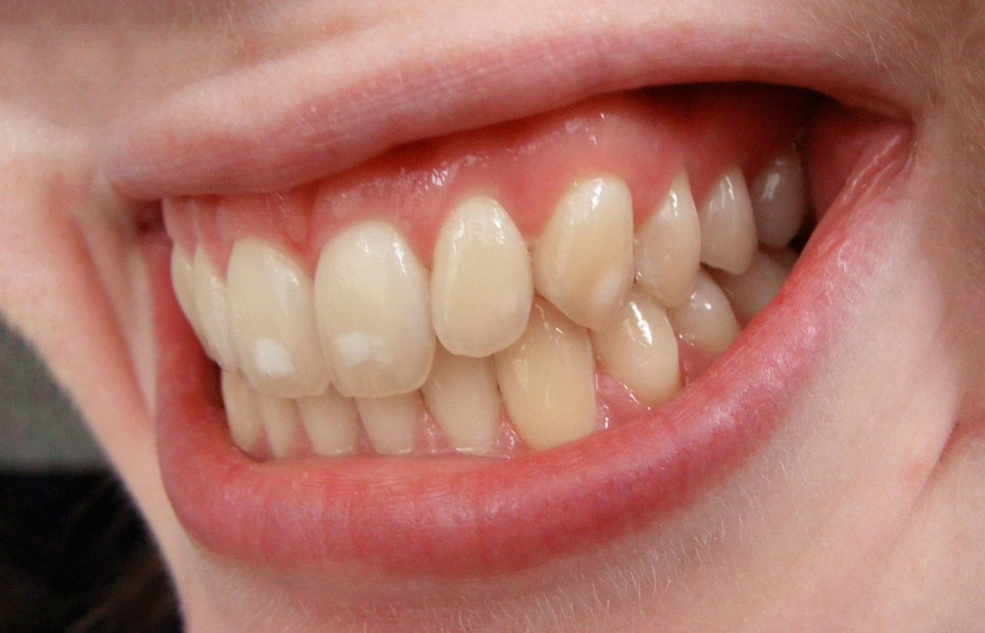 What is fluorosis? Fluorosis treatment and prevention