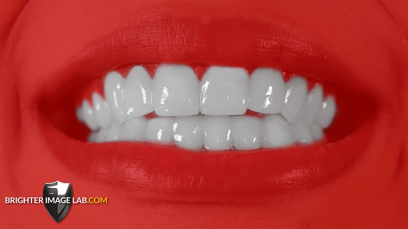 bilveneers-client-after-red-1.png