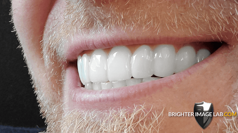 bilveneers-client-ronald-s.png