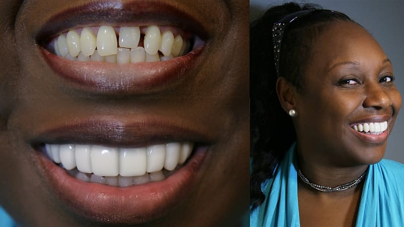 Challenge Smile Makeover by Brighter Image Lab