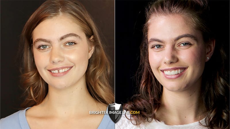 LilyBeforeAfterFullFace.jpg