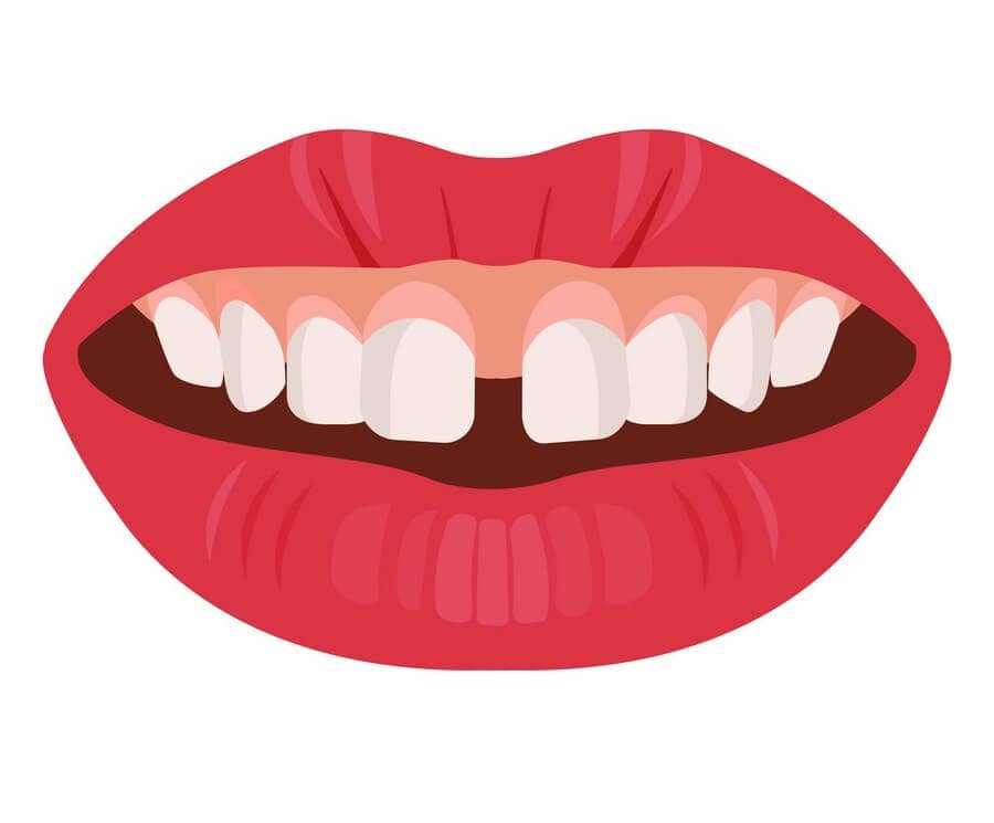 Gap Teeth How to Fix Yours Without Paying Thousands PressOn Veneers Brighter Image Lab