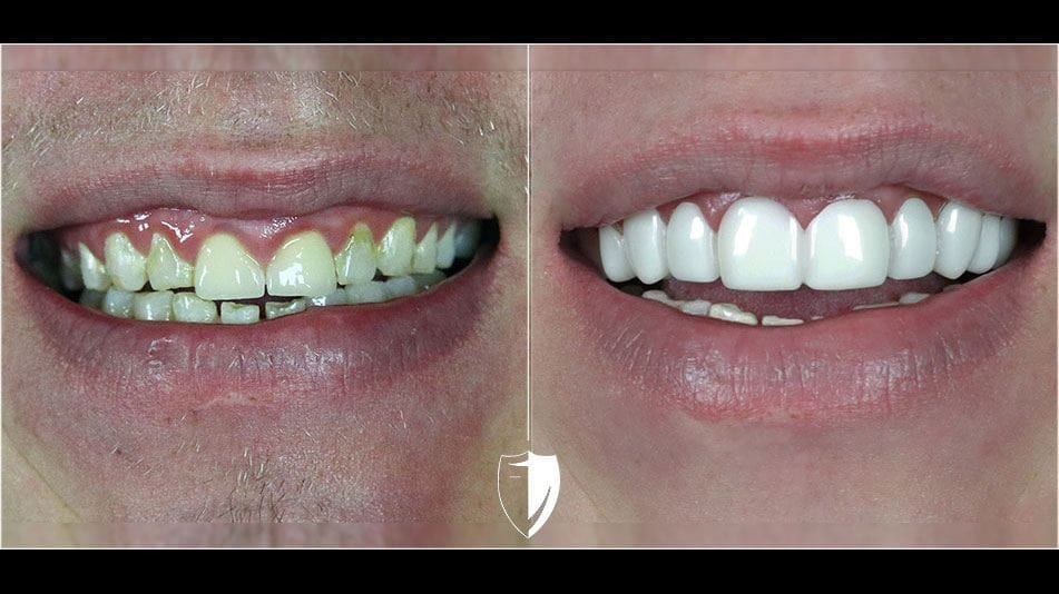 BilVeneers client Justin V before and after