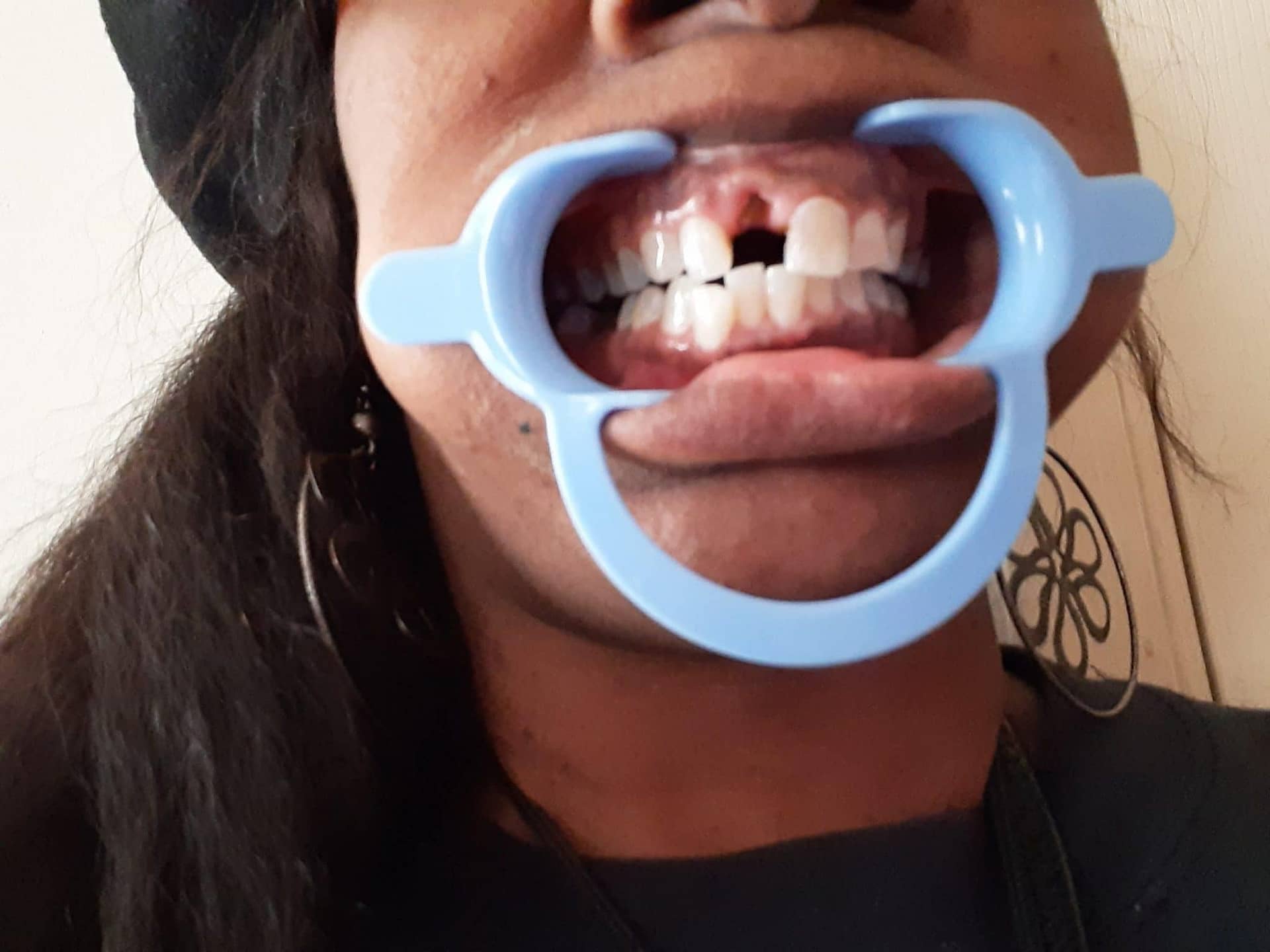 dental partials