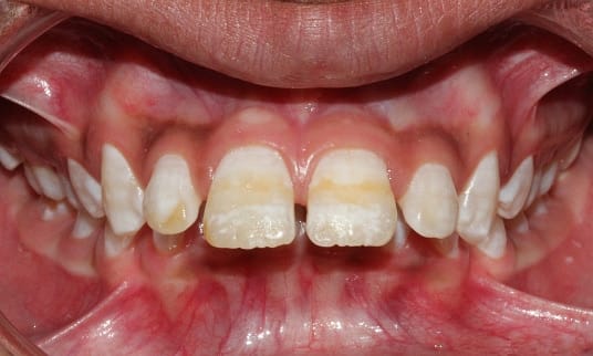 fluorosis treatment and prevention